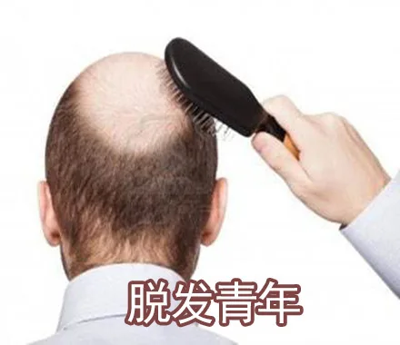 脱发青年（脱发青年）